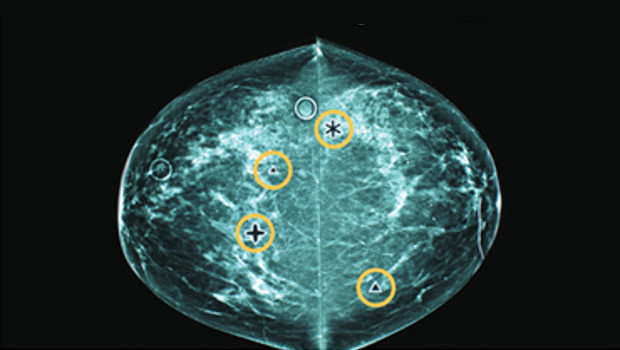 CAD-mammogram-2col.jpg