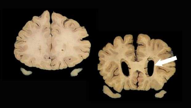 ATN-brain-scan_2col.jpg