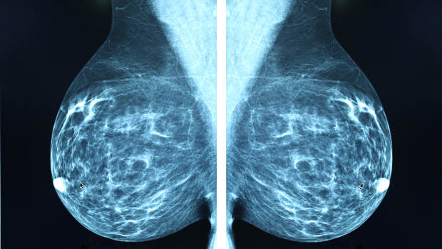mammogram-may-2017-2col.jpg