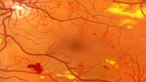 Diabetic-Retinopathy-1col.jpg