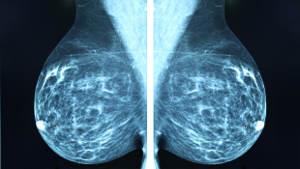 mammogram-may-2017-1col.jpg