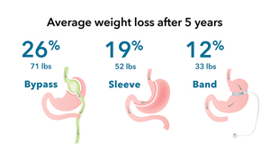 Bariatric-surgery-infographic_1col.jpg